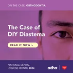 The Case of DIY Diastema